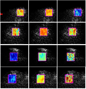 Image of a biopsy, with yellow, blue, and green squares